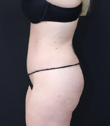 31113 - After - Side