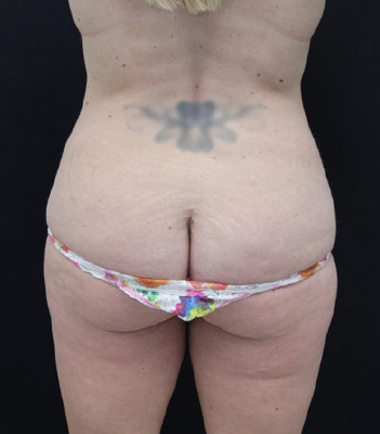 31113 - Before - Back