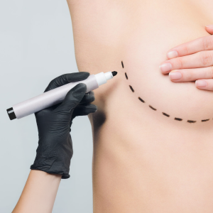 Breast Revision - Plastic Surgery Northwest