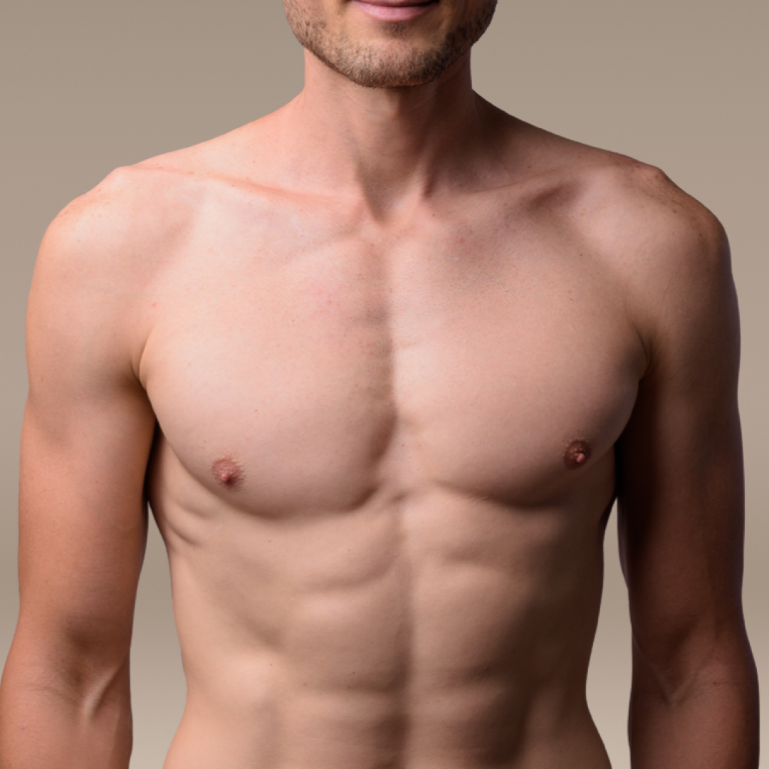 Gynecomastia sq